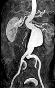 Мрт ангиография артерий головного мозга
